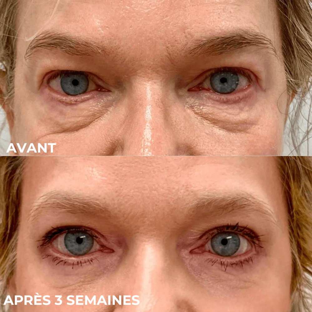 SkinSublime - Patchs pour réduire cernes, poches et fatigue