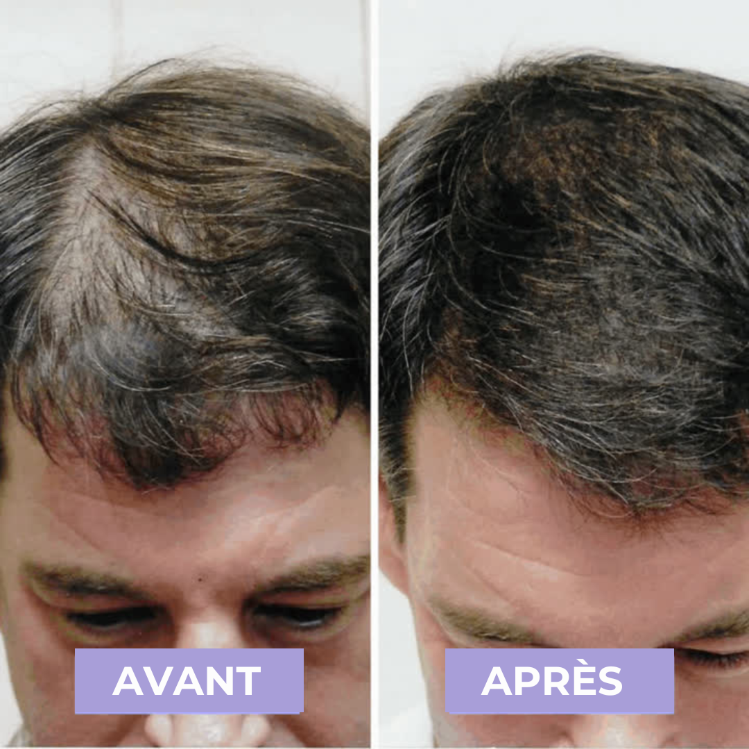 HairPulse - Brosse LED repousse cheveux